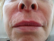 Top lip lines after dermal filler treatment
